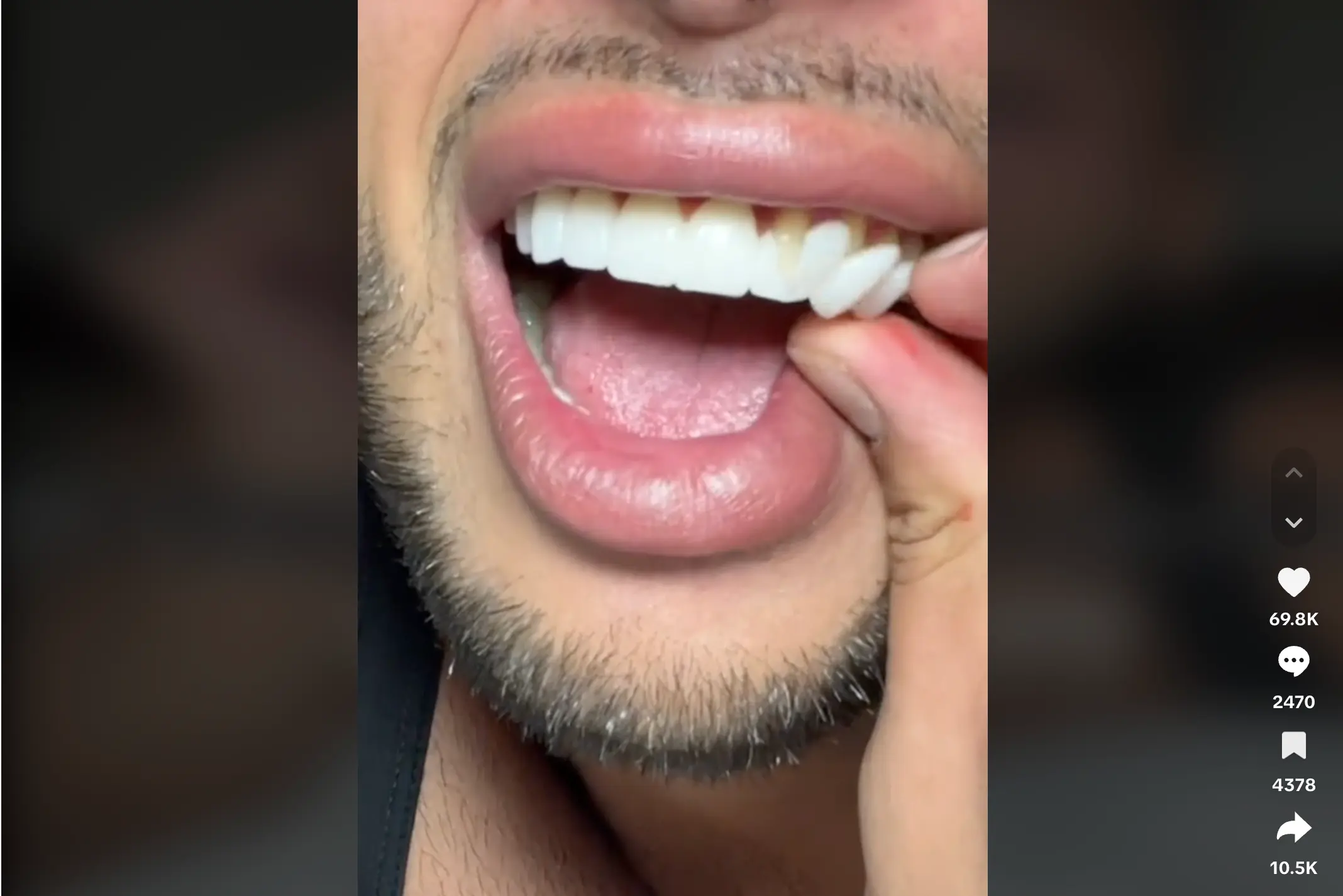 Carillas dentales en Sevilla y no en Turquía: lo barato puede salir caro